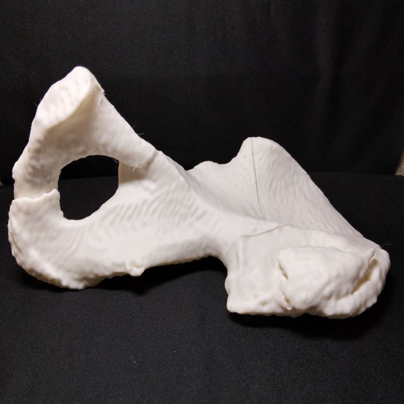 Hemipelvis